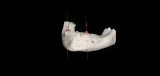 3d-Modeling για ολική οδοντοστοιχία επι εμφυτευμάτων.